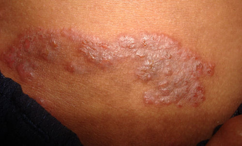 An example of a skin infection