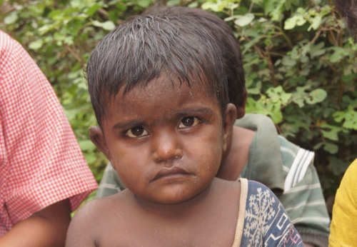Children in the slums are often bitten by mosquitos