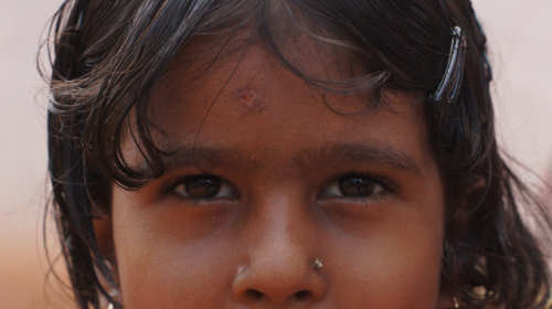 Young girl a couple of days after hitting her head