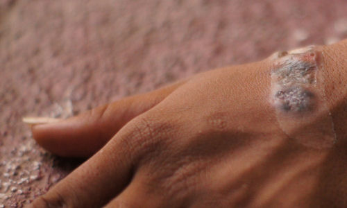 Biopsy taken for the infection on her hand for further analysis