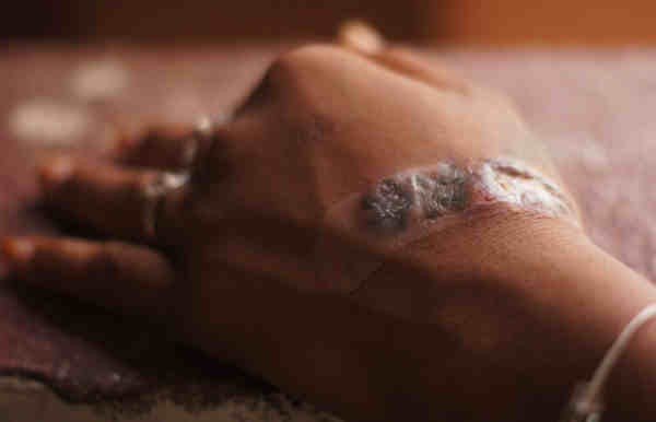 Local Tattoos react leaving an infected area on her hand