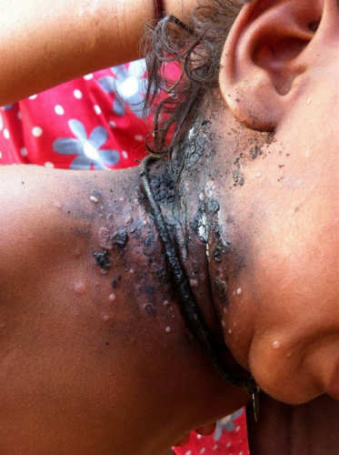Black 'ayurvedic medicine' covered the sore area