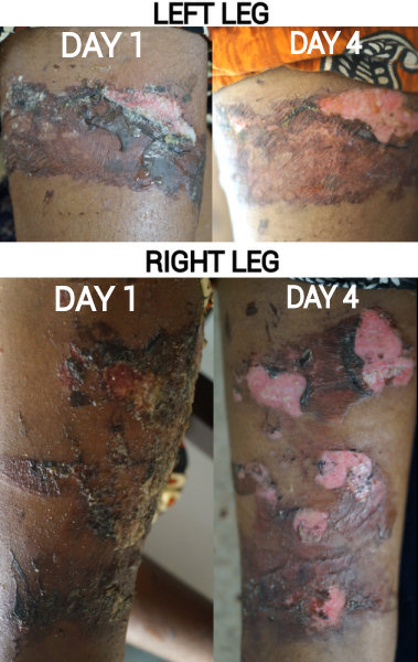 Before and After photos for one girls sore legs, her dress caught fire while keeping warm near the fire at night in the slum