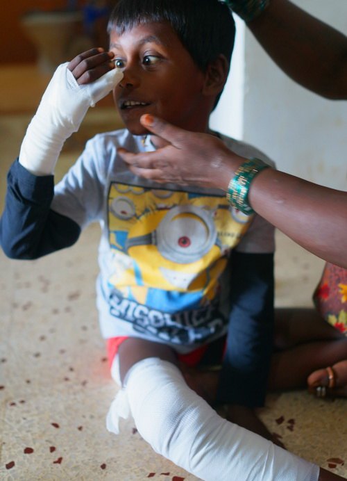 Burnt Child checking out his new bandages
