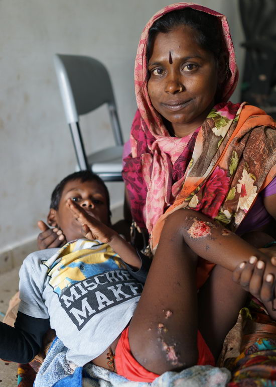 Burnt Child Found in Mapusa Market Begging having his wounds cleaned before re- dressing