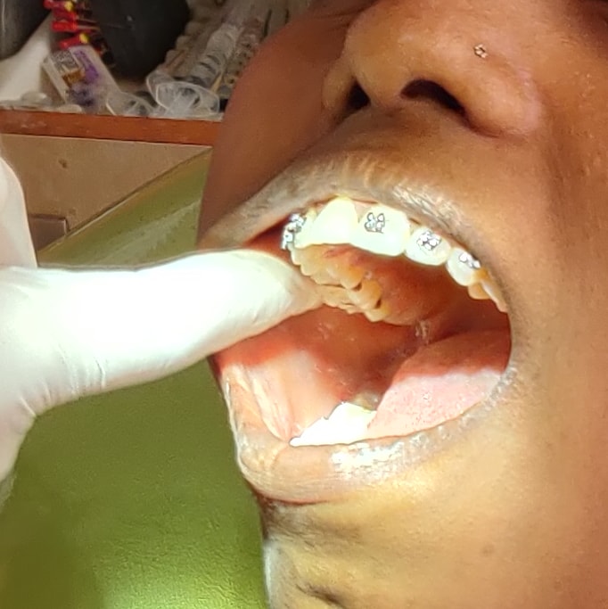 Tooth Extraction