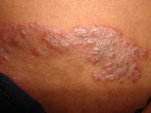 An example of a skin infection