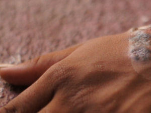 Biopsy taken for the infection on her hand for further analysis