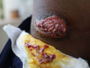 One of the childrens wounds after contracting chicken pox